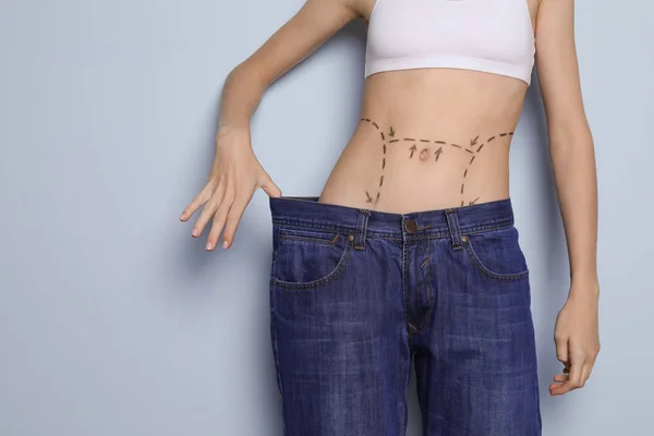在大牛仔裤腹部标记的年轻妇女在整容手术对颜色背景的操作以后 — 图库照片
