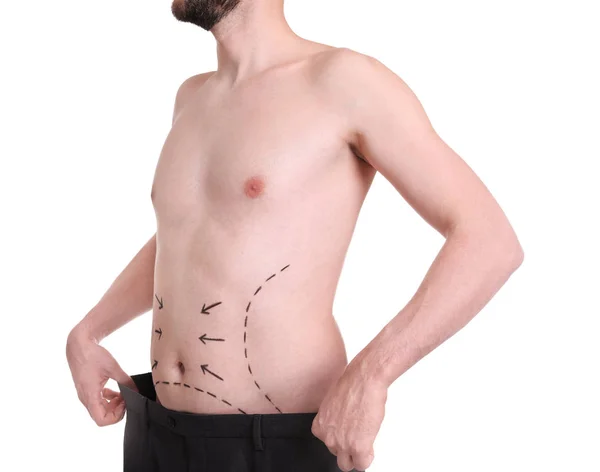 Junger Mann mit Spuren am Bauch für Schönheitschirurgie-Operation auf weißem Hintergrund — Stockfoto