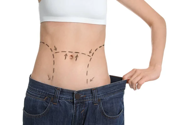 Young woman with marks on belly in big jeans after cosmetic surgery operation against white background — Stock Photo, Image