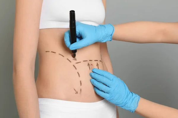 Doctor drawing marks on female belly for cosmetic surgery operation, closeup — Stock Photo, Image