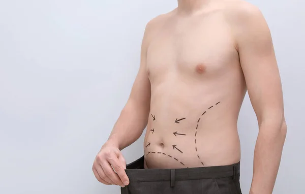 Young man with marks on belly for cosmetic surgery operation on light background