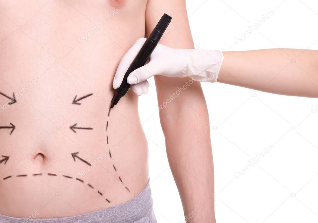 Doctor drawing lines on man's stomach with marker against white background