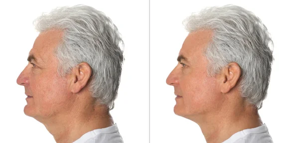 Starší muž před a po plastické operaci na bílém pozadí — Stock fotografie