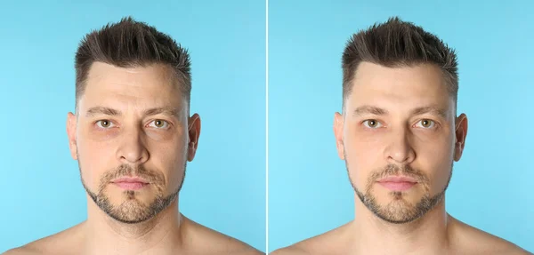 Hombre antes y después de la cirugía plástica sobre fondo azul — Foto de Stock