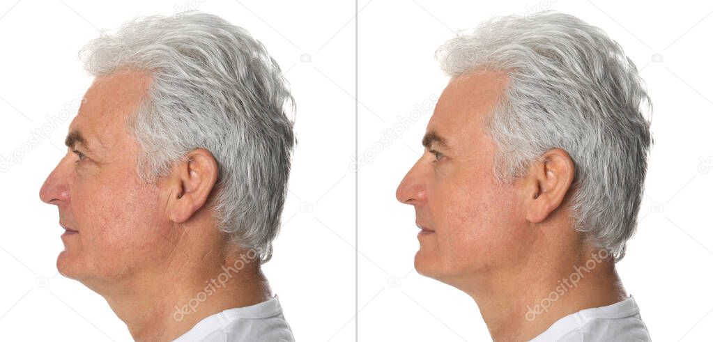 Mature man before and after plastic surgery on white background