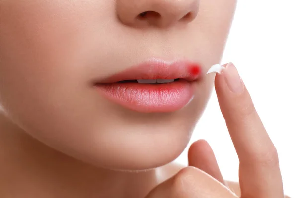 Νεαρή γυναίκα με κρύα πληγή εφαρμογή κρέμα στα χείλη σε λευκό φόντο, closeup — Φωτογραφία Αρχείου