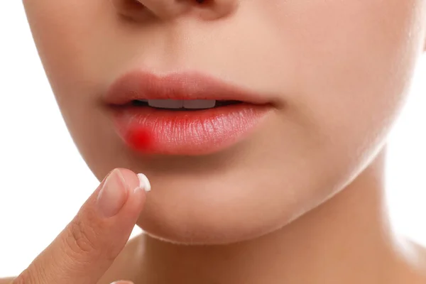 Mujer joven con herpes labial aplicando crema sobre los labios sobre fondo blanco, primer plano — Foto de Stock
