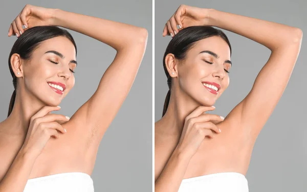 Collage Woman Showing Armpit Epilation Light Grey Background — Stock Photo, Image