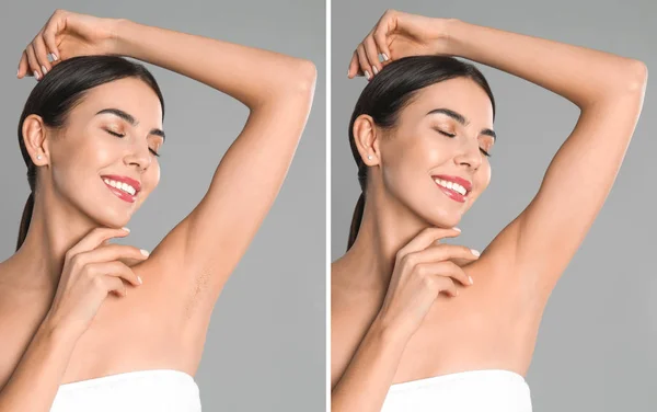 Collage Mujer Mostrando Axila Antes Después Depilación Sobre Fondo Gris — Foto de Stock