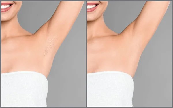 Collage Woman Showing Armpit Epilation Light Grey Background Closeup — Stock Photo, Image