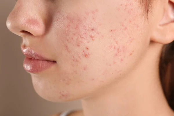 Teenage girl with acne problem on beige background, closeup — Stock Photo, Image