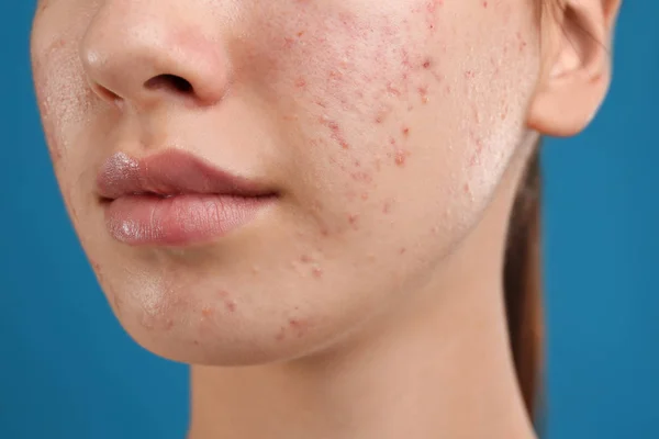Teenage girl with acne problem on blue background, closeup — Stock Photo, Image