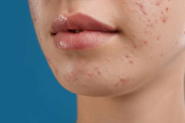 Adolescente avec problème d'acné sur fond bleu, gros plan — Photo