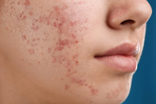 Adolescente com problema de acne no fundo azul, close-up — Fotografia de Stock