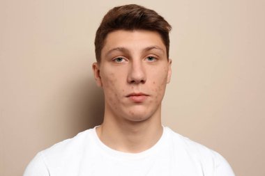 Bej arka planda sivilce sorunu olan genç bir adam.