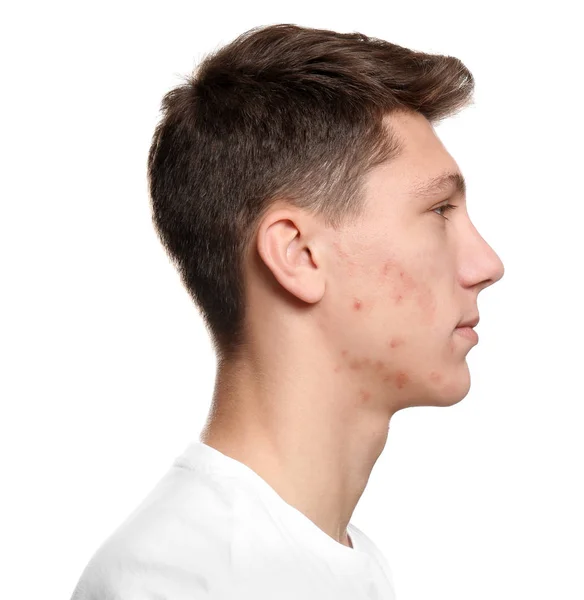 Teen Guy Acne Problem White Background — Stock Photo, Image