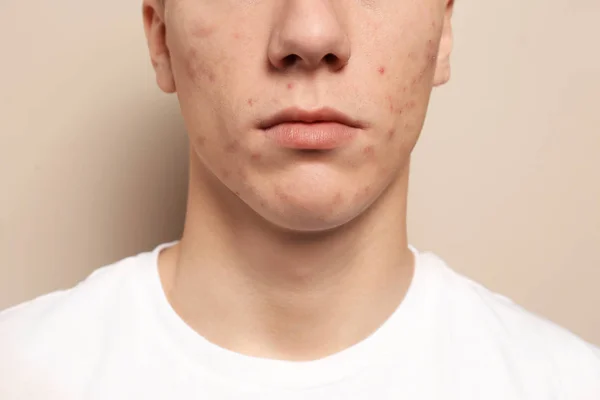 Adolescente Cara Com Problema Acne Fundo Bege Close — Fotografia de Stock