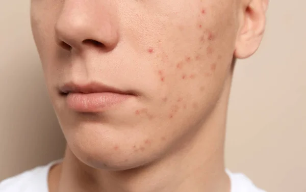 Ragazzo Adolescente Con Problemi Acne Sfondo Beige Primo Piano — Foto Stock