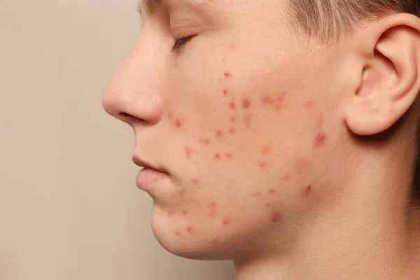 Ragazzo Adolescente Con Problemi Acne Sfondo Beige Primo Piano — Foto Stock