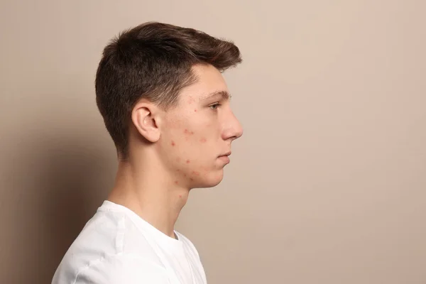 Tiener Man Met Acne Probleem Beige Achtergrond Ruimte Voor Tekst — Stockfoto