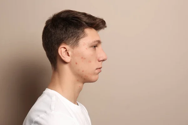 Adolescente Com Problema Acne Fundo Bege Espaço Para Texto — Fotografia de Stock