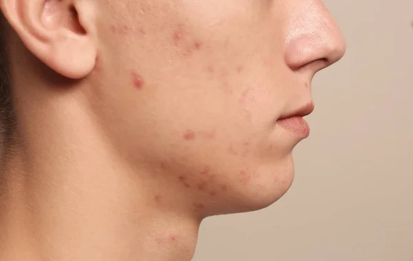 Ragazzo Adolescente Con Problemi Acne Sfondo Beige Primo Piano — Foto Stock