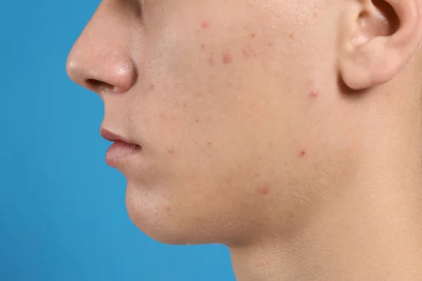 Adolescente Cara Com Problema Acne Fundo Azul Close — Fotografia de Stock