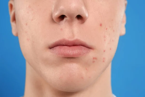 Teenager Mit Akne Problem Auf Blauem Hintergrund Nahaufnahme — Stockfoto
