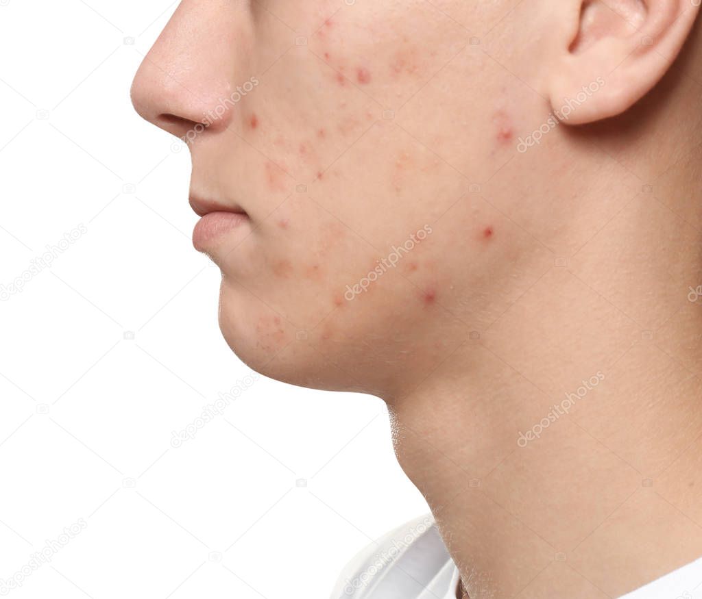 Teen guy with acne problem on white background, closeup