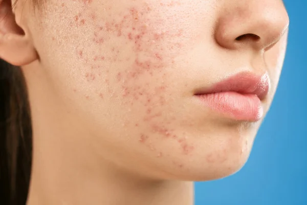 Tiener meisje met acne probleem op blauwe achtergrond, close-up — Stockfoto