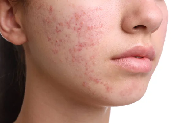 Adolescente com problema de acne no fundo branco, close-up — Fotografia de Stock