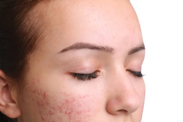 Tiener meisje met acne probleem op witte achtergrond, close-up — Stockfoto