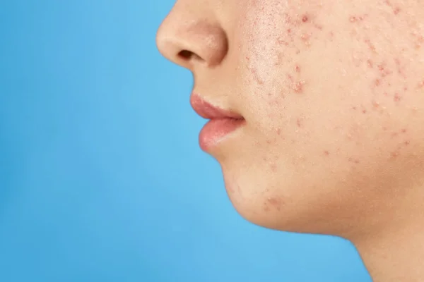 Adolescente avec problème d'acné sur fond bleu, gros plan — Photo