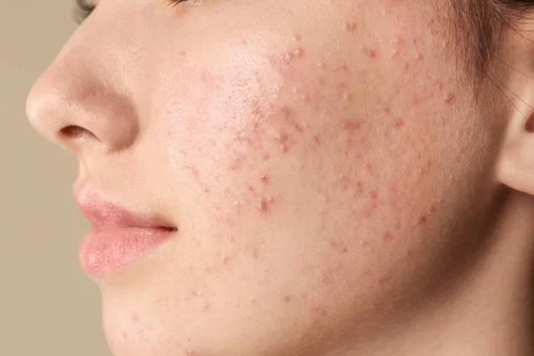 Teenage girl with acne problem on beige background, closeup