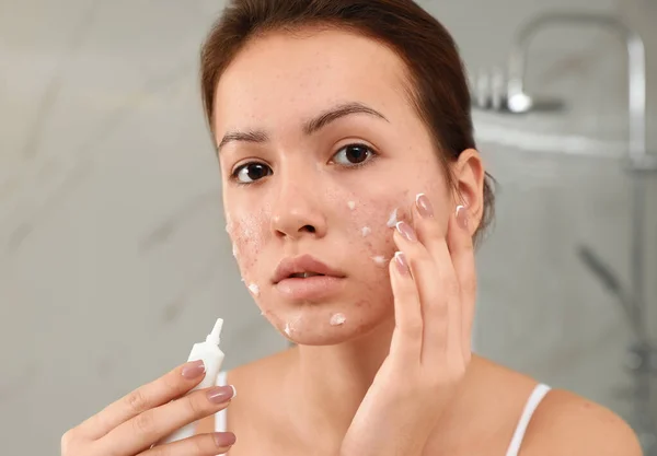 Chica adolescente con problemas de acné aplicación de crema en el baño — Foto de Stock