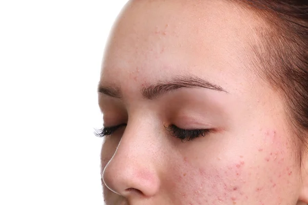 Teenage girl with acne problem on white background, closeup — Stock Photo, Image