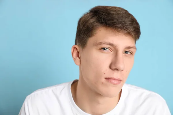 Adolescent guy avec acné problème sur lumière bleu fond — Photo