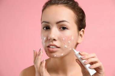 Sivilceli genç bir kız açık pembe sırt deliğine krem sürüyor.