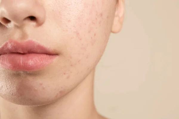 Adolescente com problema de acne no fundo bege, close-up — Fotografia de Stock