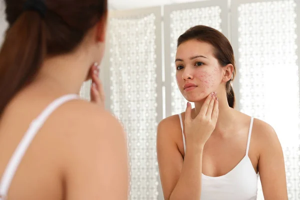 Teen girl with acne problem near mirror in bathroom — Stock Photo, Image