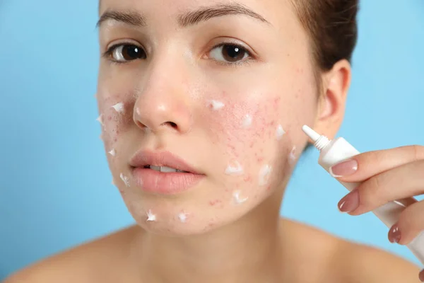 Teen girl with acne problem applying cream on light blue backgro