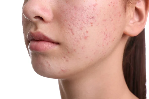 Adolescente com problema de acne no fundo branco, close-up — Fotografia de Stock