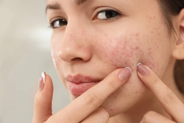 Teen girl with acne problem squeezing pimple on her face, closeu — Stock Photo, Image