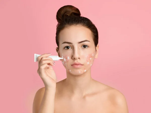 Teen girl with acne problem applying cream on light pink backgro — Stock Photo, Image