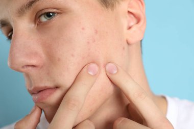 Sivilceli genç adam açık mavi sırtında sivilce çıkarıyor.