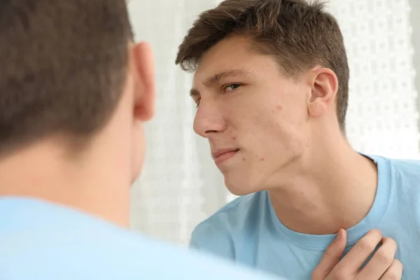Teen guy with acne problem near mirror indoors — Stock Photo, Image