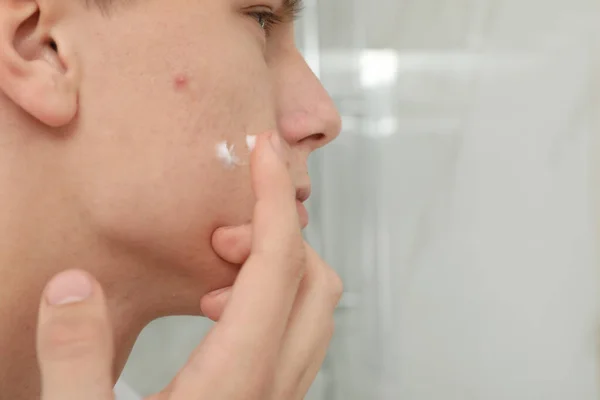 Adolescente cara com acne problema aplicando creme dentro de casa, close-up — Fotografia de Stock