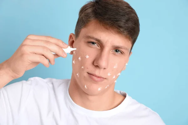 Adolescente cara com problema de acne aplicando creme no backgrou azul claro — Fotografia de Stock