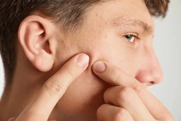 Teen guy with acne problem squeezing pimple on his face on light — Stock Photo, Image