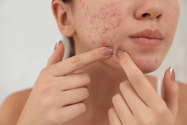 Teen girl with acne problem squeezing pimple on her face, closeu — ストック写真